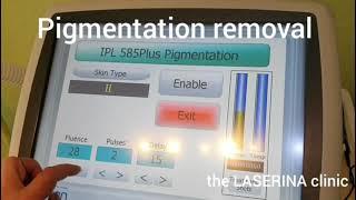 Pigmentation removal