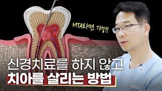 공포의 신경치료, 안 해도 된다고?! | 이유가 궁금하다면 Click️