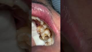 Composite restoration for first molar  tooth #dentist