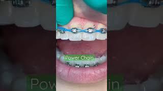 How Power Chain put on the Braces bracket|Orthodontic Treatment|How powerchain work|Ortho Dentistry