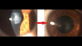 Can Corneal Scars be Treated? Yes LaZrPlastique @GulaniVision