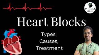 Heart Blocks (Types, Causes, ECG findings, Treatment)