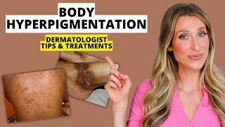 Dermatologist Explains Body Hyperpigmentation: What Causes It, Best Treatments, Prevention, & More!