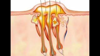 Обучающее видео. Карбункул
