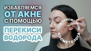 Лечение акне с помощью перекиси - Избавляемся от прыщей!