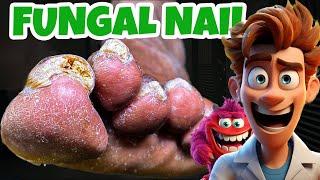 SUPER THICK FUNGAL TOENAIL and Deep Callus!