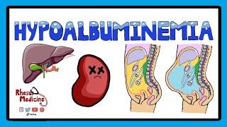 Hypoalbuminemia - Functions of Albumin in the Body + Pathophysiology of Hypoalbuminemia