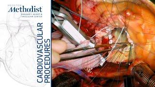 Acute Type-A Aortic Dissection Repair with Bentall Procedure (Ramchandani MD, Spooner MD, Zubair MD)