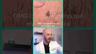 Derm reacts to HUGE ingrown hair! #dermreacts #doctorreacts #ingrownhair