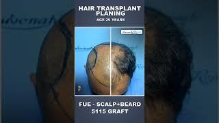 Hair Transplant in Indore #shorts