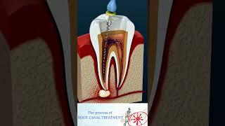 Root Canal Treatment & Tooth Abscess