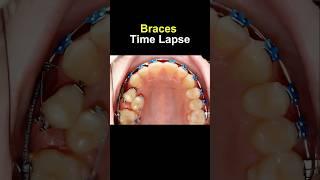 Braces time lapse. Before and after transform #braces #orthodontist #bracesoff #dentist