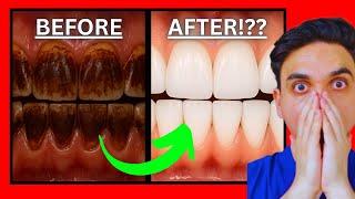YELLOW Teeth to WHITE Teeth UNDER 60 Seconds