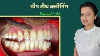 deep teeth cleaning | danto ki safai । Episode - 26