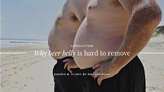 Why beer belly is hard to remove | Amaris B. Clinic by Dr Ivan Puah