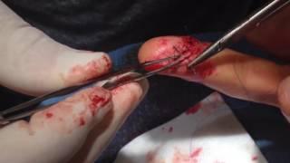 Finger Repair ~ Wound in fingertips sealing procedure by Dr. Greg Casey Casey Cosmetic Surgery