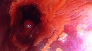 Example of negative Staining of Esophageal Squamous Dysplasia using Lugol's Iodine Chromoendoscopy