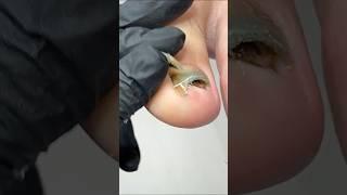 Hidden Infection? Ingrown Nail? Watch This Relief!