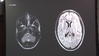 Meningitis recurrente en VIH: Infección vs inflamación