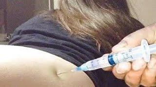 IM Intramuscular injection Push in the Buttocks ketolac & paracetamol & Dexamethasone (ventrogluteal