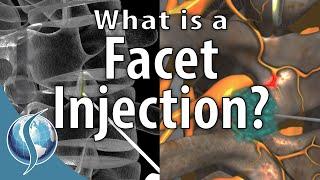 What is a Facet Injection?