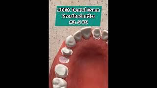 ADEX Dental Exam - Prosthodontics Crown Preps #adex #dental #exam #dentist