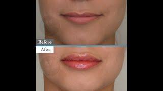 Lip Augmentation at NewDermaMed Cosmetic and Advanced Laser Clinic | Lip Filler Injection