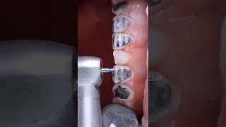 Dental motivation. Preparation teeth. Ceramic veneers. #dentistry #dental