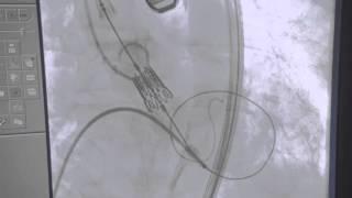 Medical Procedures | Stent Placement