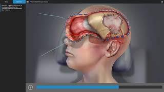 Traumatic Brain Injury - Brain Surgery Animation