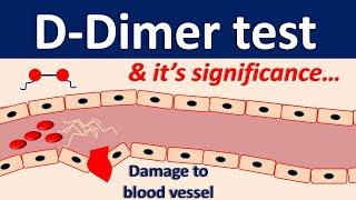 D-dimer test and its significance