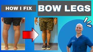 The ONLY way to Fix Bow Legs! - Get the Facts