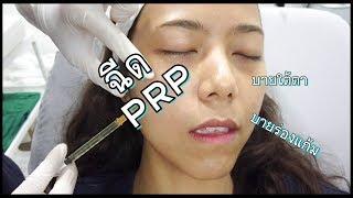 #หนัมจะVlog ไปฉีด PRP กันจ้า บายร่องแก้ม บายใต้ตา