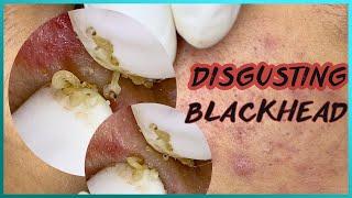 Big Cystic Acne Blackheads Extraction Blackheads & Milia, Whiteheads Removal Pimple Popping