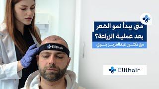 When Will Transplanted Hair Start to Grow? And Can it Fall Again!! | With Dr.Balwi