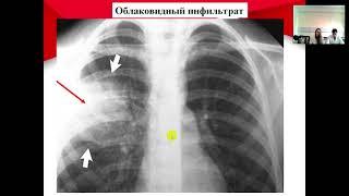 ТРУДНОСТИ ЛУЧЕВОЙ ДИАГНОСТИКИ ПРИ ИНФИЛЬТРАТИВНОМ ТУБЕРКУЛЕЗЕ