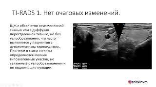 ИСПОЛЬЗОВАНИЕ TI-RADS (ТИРАДС) В ПРАКТИКЕ ВРАЧА УЛЬТРАЗВУКОВОЙ ДИАГНОСТИКИ. Часть 1.