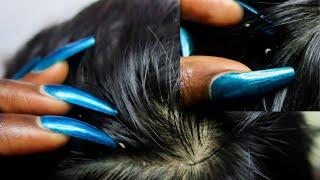 ASMR Allzoomed Full Head Scalp Nitpicking Whiteheads 1HR .