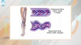 Рубрика "PRO здоровье": варикозное расширение вен