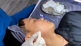 Heavy pimples on face #acne #acne #pimples #blackheads #skincare #comedy #facial #funny
