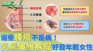 這些腫瘤不是病！乳房纖維腺瘤 好發年輕女性 健康2.0