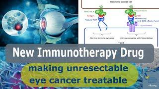 New Immunotherapy Makes Unresectable Eye Cancer Treatable