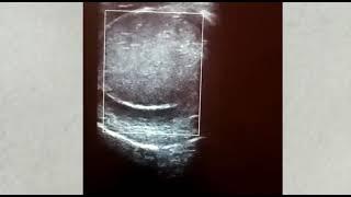 Testicular torsion ultrasound... Dr Albashir Osman Bahar Abakar