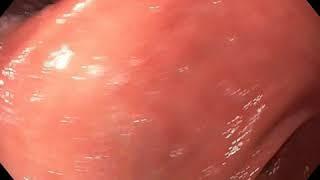 H. Pylori Gastritis Endoscopy