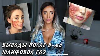 ЛАЗЕРНАЯ ШЛИФОВКА лица | ВСЯ ПРАВДА (много фото) | CO2 лазер