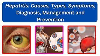 Hepatitis: Types, Causes, Symptoms, Diagnosis, Management and Prevention