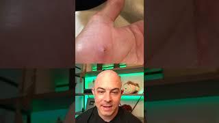 Derm reacts to super satisfying infected splinter removal! #dermreacts #doctorreacts #splinter