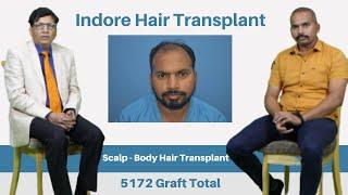 Best Hair Transplant in Bhopal | After Hair Transplant Experience in Bhopal | Dr. Anil Garg Bhopal