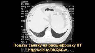 Второе мнение КТ легких - что показывает расшифровка - правостороннюю пневмонию