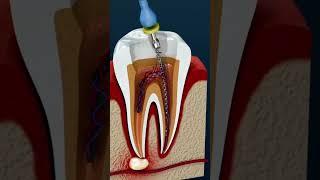 What is a Root Canal? Do I need a Root Canal? #rct #dentist #dentalcrowns #teeth